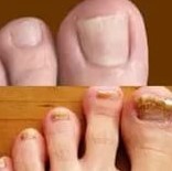 Chạy một hình thức của nấm